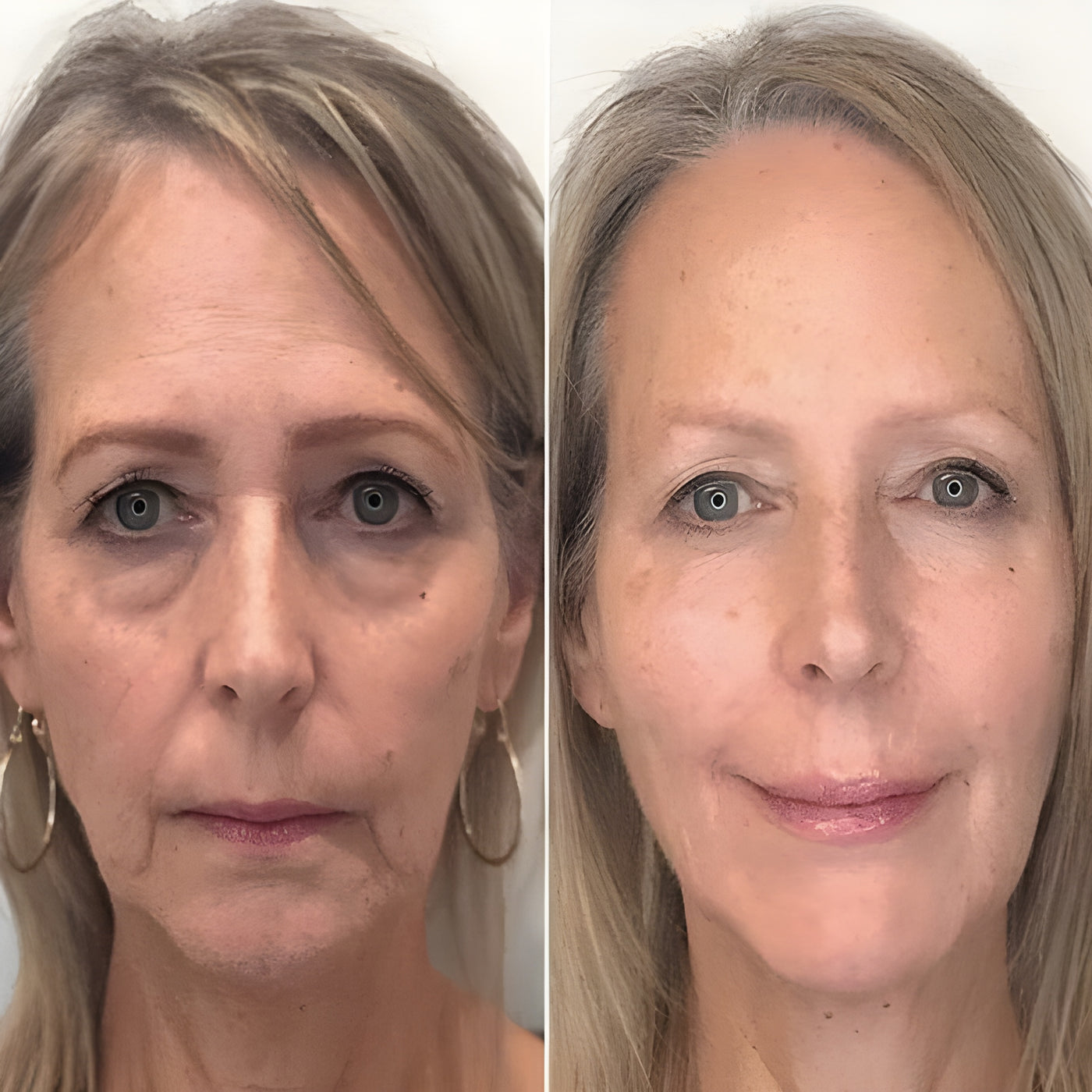 Instant Silmänympärys Lift™ | 1+1 ILMAISEKSI