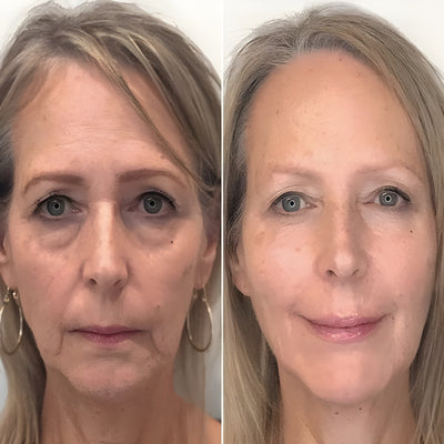 Instant Silmänympärys Lift™ | 1+1 ILMAISEKSI
